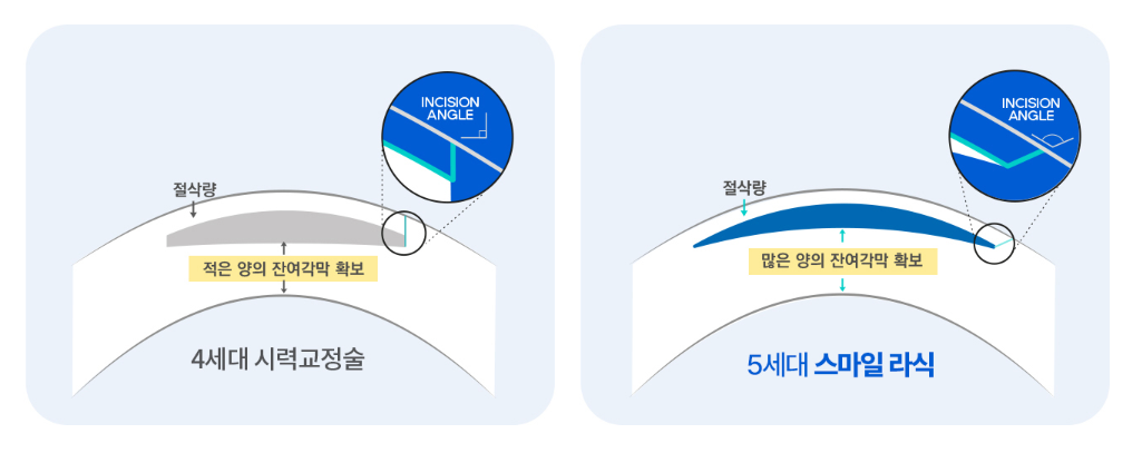강남스마일라식잘하는곳